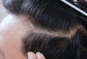 white gunk on scalp